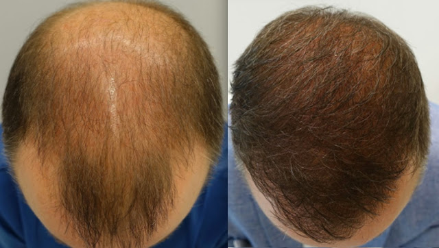 Un uomo di 39 anni prima e dopo il trapianto di capelli con il metodo DHI a Tirana