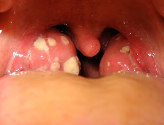 qué es la amigdalitis, boca de persona afectada 