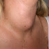 What Are the symptoms of thyroid cancer - Types of thyroid cancer.