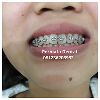 gambar foto behel bracket kawat gigi sebelum dan sesudah perawatan untuk memperbaiki merapikan gigi gingsul gigi miring renggang tonggos berantakan keluar masuk jarang diastema maju mundur tidak rapi tidak beraturan bali denpasar banyuwangi jember tidak rata kocar kacir