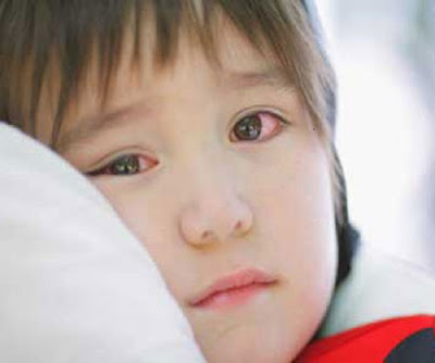 Lây đau mắt đỏ qua đường sinh hoạt hàng ngày
