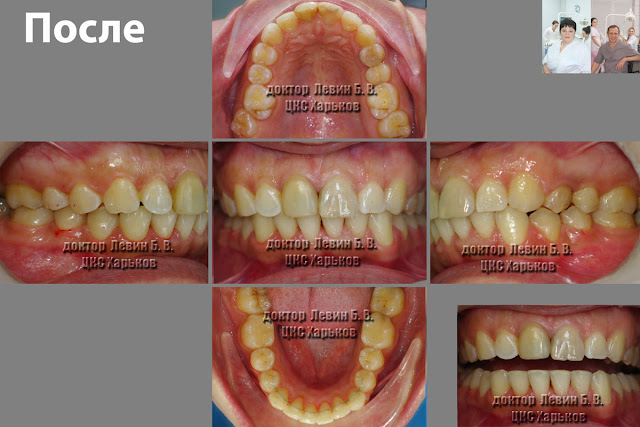На иллюстрации 5 фото, всех проекций прикуса пациента после лечения