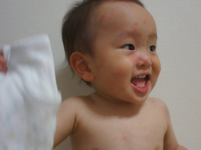 選択した画像 水疱瘡 赤ちゃん 画像 157207-水疱瘡 赤ちゃん 画像