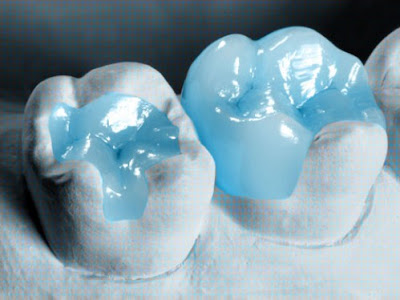 Trám răng composite có bền không? Kiến thức nha khoa-1