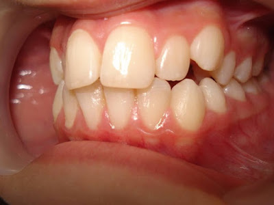 Khi nào phải dùng thêm mini vit hỗ trợ niềng răng chỉnh nha?