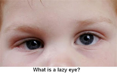 Lazy Eye Causes, Diagnosis And Treatment | What is a lazy eye?