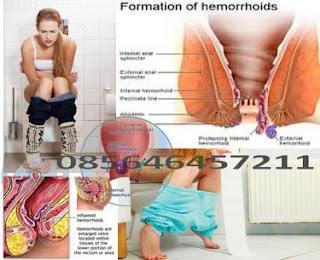 Obat Tradisional Wasir atau Hemorrhoid Akut 