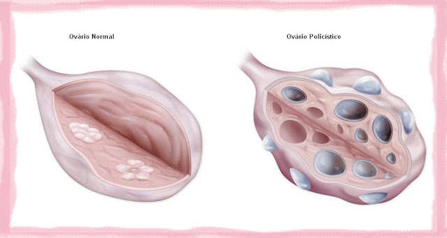 Sindrome dos ovarios policisticos
