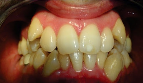  Que tratamientos seguir cuando los dientes están montados o mal posicionados