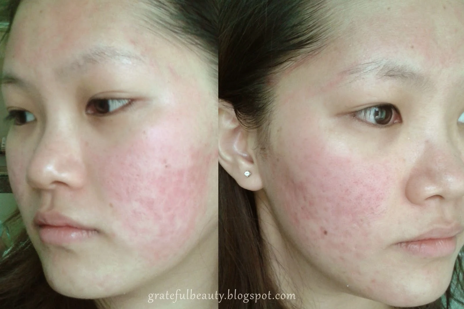 Story Of Acne Pengalaman Mencoba Treatment Untuk Menghilangkan