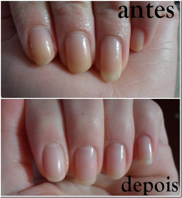 unhas amarelas