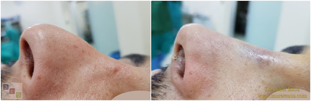 Treatment of Pollybeak Deformity - Cartilage Pollybeak Deformity - Cartilaginous Pollybeak Deformity - Tertiary Revision Rhinoplasty For Pollybeak Deformity  - Tertiary Revision Nose Job For For Pollybeak Deformity