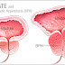 Prostatic Hyperplasia