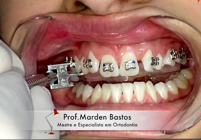 ORTODONTIA: Posicionamento de bráquetes em casos de Tracionamento de Caninos