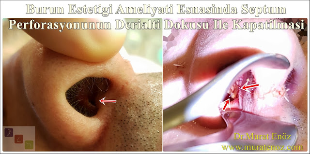 Deri altı dokusu ile septum perforasyonu tamiri - Deri altı dokusu ile septum perforasyonu ameliyatı - Septum perforasyonu tedavisi - Nazal septum perforasyonu operasyonu - Açık teknik septum perforasyonu ameliyatı - Açık teknik septum perforasyonu onarımı - Burun estetiği ile birlikte septum perforasyonu kapatılması - Burun septumunda delik kapatılması - Burun septum perforasyonu ameliyatı - Septum perforation closure in Istanbul - Septum perforation closure with under skin tissue - Closure of nasal septal perforations using under skin tissue - Combining rhinoplasty with septal perforation repair