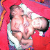 Video...Kelahiran  Bayi Kembar Siam Yang Bercantum Di Bahagian Perut 