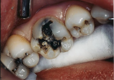 Tình trạng răng bị mẻ một nửa phải làm sao?-1