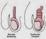 testicolare torsione