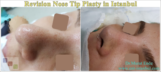 Revision Aesthetic Nose Tip Surgery,Revision Nose Tip Plasty in Istanbul,