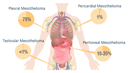 Testicular Mesothelioma