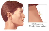 Filiform Warts