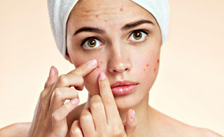 Top 10 tips for acne