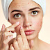 Top 10 tips for acne