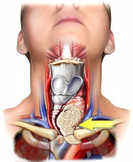   Types Of Most Common Cancer,Early Skin Cancer,Primary Liver Cancer,Most Common Cancer Types