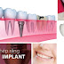 Các kinh nghiệm làm răng implant nên biết