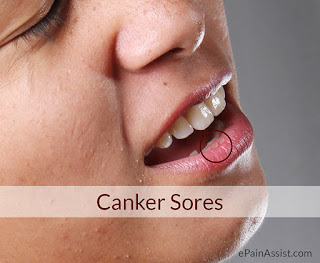 tomatitis Aphtous Atau Canker Sore