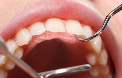 Viêm lợi có niềng răng được không? Phải làm sao? 1