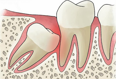 Yếu tố quyết định nhổ răng khôn có nguy hiểm không?