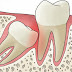 Yếu tố quyết định nhổ răng khôn có nguy hiểm không?
