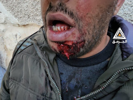 A Palestinian injured man