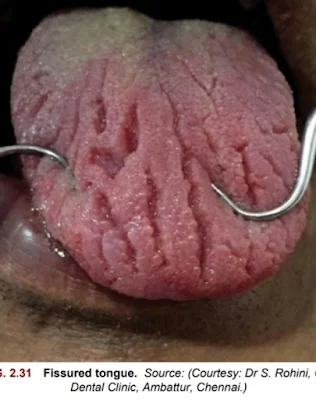 Fissured tongue