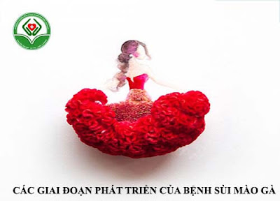 các giai đoạn phát triển của sùi mào gà