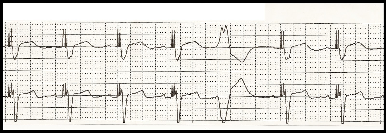 heart test ekg 03 Rhythm Basic ECG Test Float Nurse: heart test ekg 03 Rhythm Basic ECG Test Float Nurse: