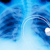 Fda Recalls About One-Half A 1000000 Pacemakers Over Hacking Fears