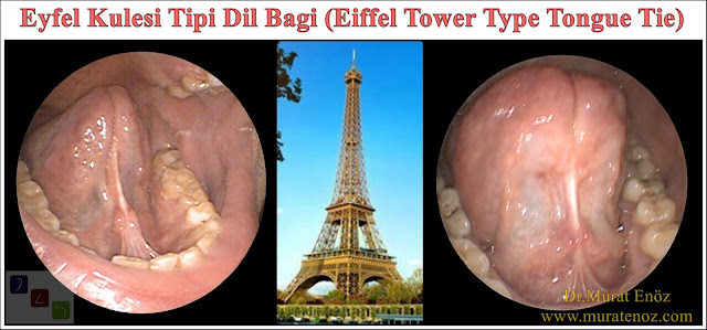 Eyfel Kulesi Tipi Dil Bağı - Eiffel Tower Type Tongue Tie - Piston Tipi Dil Bağı - Piston Type Tongue Tie - Dil bağı ameliyatı - Dil Bağı kesilmesi - Dil altı bağı kesilmesi - Dil bağı operasyonu - Tongue tie relase surgery
