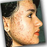 Por lo tanto, lo que voy a hacer es compartir con ustedes algunas maneras de cómo curar pimples.The 5 maneras de curar las espinillas son. De esta manera, será más seguro y tener una piel limpia y clara....