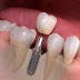 Quy trình trồng răng implant