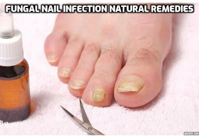 Fungal nail infections, also known as onychomycosis, can be persistent and challenging to treat. In this post, we will explore several natural remedies for treating fungal nail infections.