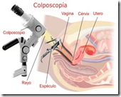 Colposcopia