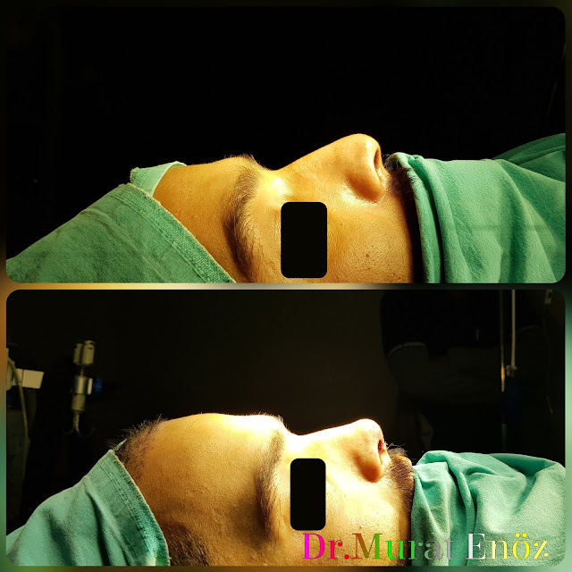 Nose Tip Plasty, Nose Tip Lifting,droopy nose tip,