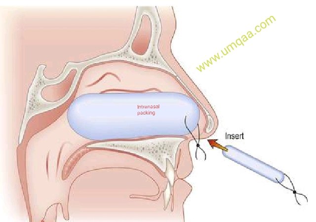 nasal pack