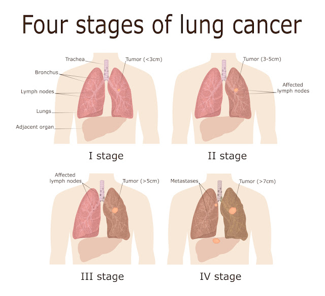 CANCER SYMPTOMS