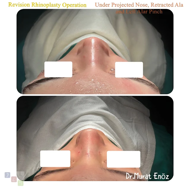 revision rhinoplasty, underprojected nose, retracted ala, alar pinch deformity, secondary nose surgery, nasal tip correction, rhinoplasty complications
