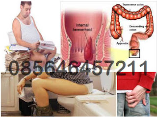 Tanda Gejala Ambeien Dalam Internal Pada Laki Laki