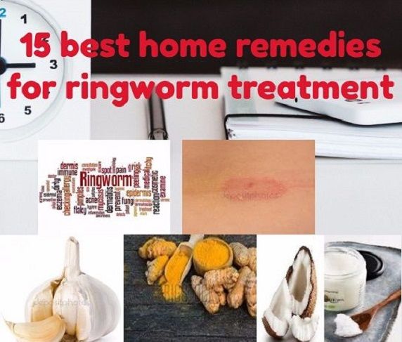 15  best home remedies for ringworm  treatment