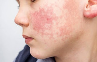 Skin-Allergy Treatment